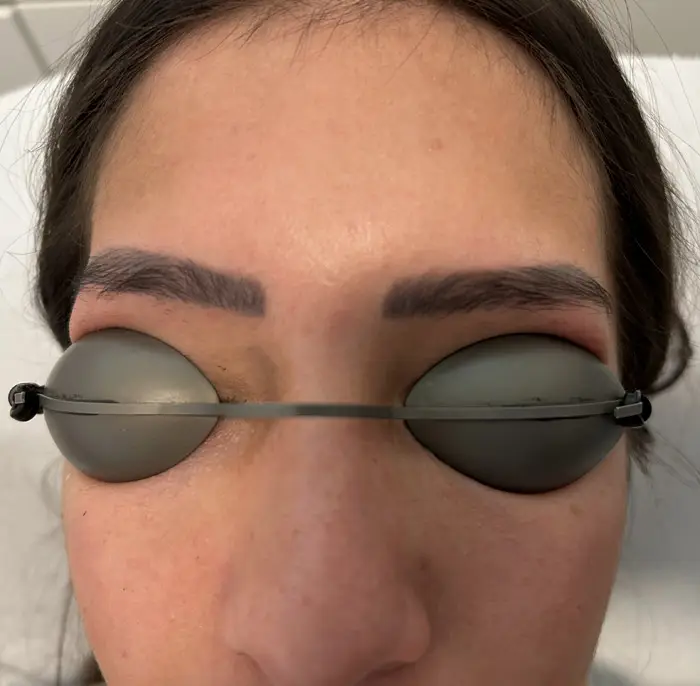 Permanent Make-up entfernen per Laser in Berlin