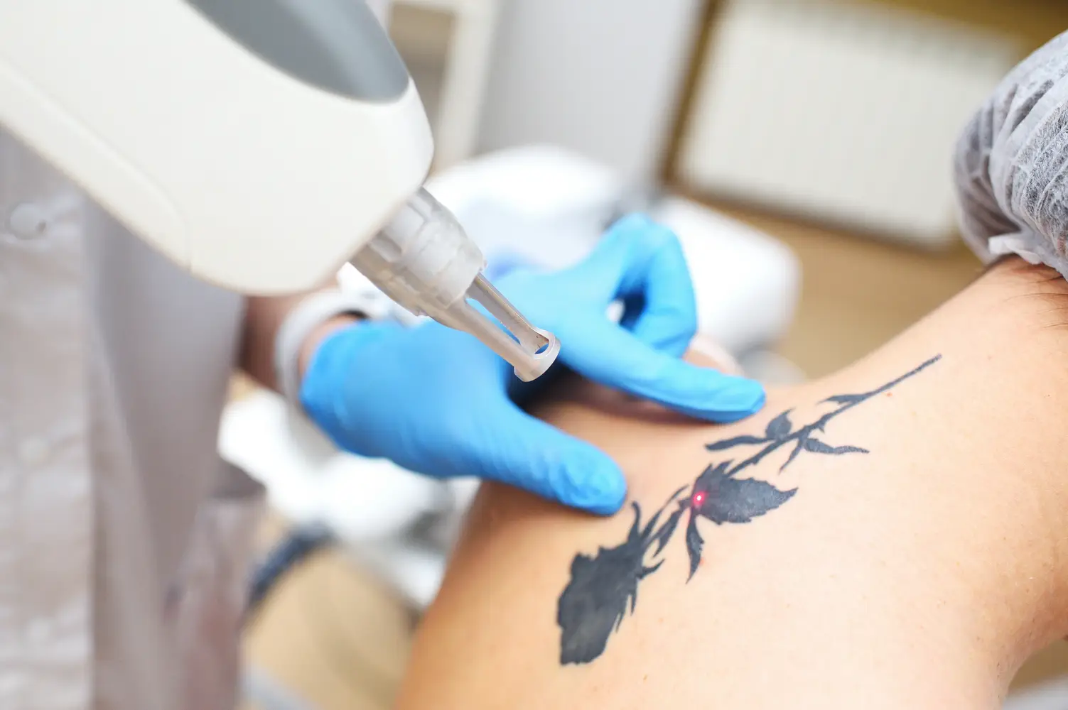Tattooentfernung per Laser in Berlin